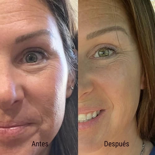 Discos Limpiadores y Exfoliantes de Cúrcuma y Ácido Kójico - ¡Llévate 2 por el precio de 1! 😍